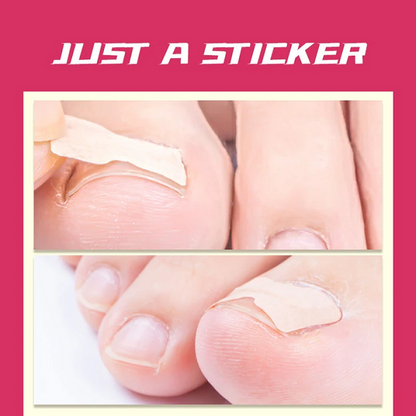 Parche para uñas de los pies sin pegamento (50 uds.)