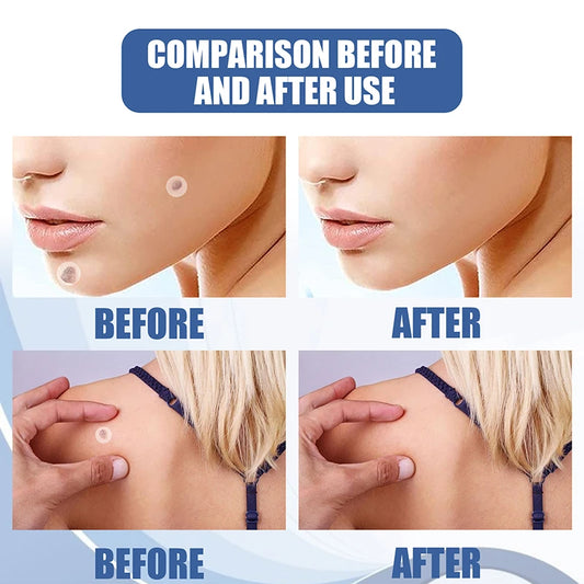 skin tag patches®️⭐⭐⭐⭐⭐ ORIGINAL